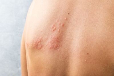 Apa Itu Herpes Zoster atau Cacar Ular?